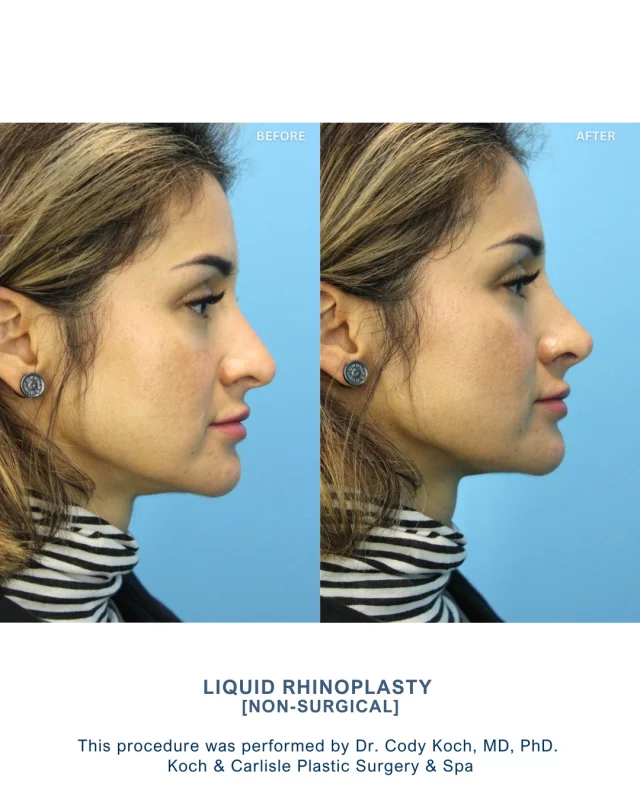 Subtle and beautiful results of a liquid rhinoplasty performed by Dr. Cody Koch, MD, PhD of Koch & Carlisle Plastic Surgery in West Des Moines. ✨

Liquid rhinoplasty is performed by injecting dermal filler into the skin of the nose. 

Many of our patients love this non-surgical option to a rhinoplasty as results are instant, no downtime is needed, it can reshape the bridge (dorsum) and tip of the nose, and it costs less than a nose surgery. 

If you are looking for a permanent option, we suggest meeting with Dr. Cody Koch for a rhinoplasty procedure to see if you are a candidate. 

Liquid rhinoplasty or injection consultations are complimentary at Koch & Carlisle Plastic Surgery & Spa. If you're interested in learning more about this service, we're happy to help:
🩵 Speak with a member of our team | 515-277-5555, press "1" for injections
💻 Inquire online | https://www.kochandcarlisle.com/consultation-mobile/

.
.
.
#boardcertified #boardcertifiedplasticsurgeon #kochandcarlisleplasticsurgery #kochandcarlisle 
#liquidnosejob #dermalfiller #liquidrhinoplasty #westdesmoines #westdesmoinesiowa