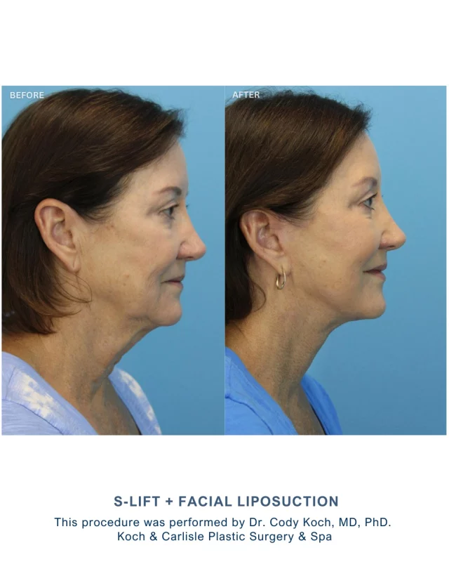 Swipe over to see the results of an S-Lift with facial liposuction by Dr. Cody Koch, MD, PhD! 😍

Following her surgery, our patient said she's "very satisfied," noting her results were "exactly what I was looking for." 

We're thrilled for her! 🩵

Dr. Cody Koch, MD, Ph.D., is a board-certified facial plastic surgeon who exclusively performs face and neck surgery at Koch & Carlisle Plastic Surgery & Spa. Patients seeking a facelift benefit from his expertise, advanced training, and commitment to natural results.

Interested in meeting with Dr. Koch for an in-person consultation? We'd here to help! 
💻 Inquire online | https://www.kochandcarlisle.com/contact-us/
🩵 Speak with a member of our team | 515-277-5555, press "1" for consultations

#facelift #boardcertified #boardcertifiedplasticsurgeon #medicalspa #westdesmoines #desmoinesiowa #drcodykoch #kochandcarlisleplasticsurgery #kochandcarlisle #slift