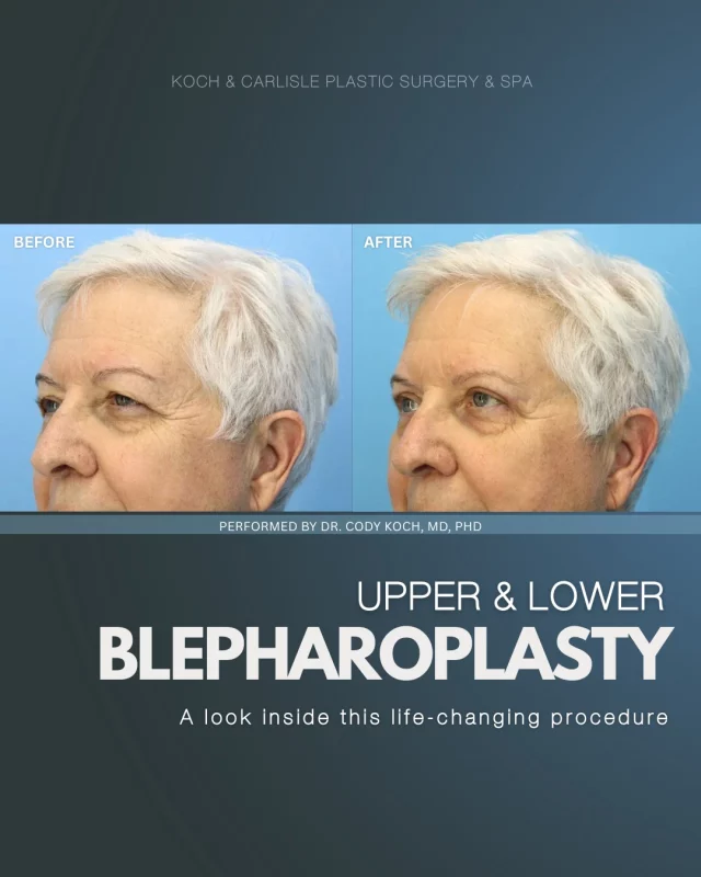 Highlighting one of our most popular facial surgeries: blepharoplasty! 🩵

During eyelid surgery, Dr. Cody Koch corrects the sags and bags that develop in the eyelids with age. As a facial plastic surgeon, Dr. Koch specializes in creating subtle improvements that elevate what you love most about how you look. 

Following the procedure, our patients appreciate their refreshed, youthful results.

Whether you are looking to turn back the clock or refine your features, you can rely on results that bring out the best in your appearance without conveying any obvious signs you’ve had a procedure done.

Interested in meeting with Dr. Koch for an in-person consultation? We would love to help!
➡ Speak with a member of our team | 515-277-5555, press "1" for consultations
➡ Inquire online | https://www.kochandcarlisle.com/consultation-mobile/

.
.
.
.
#boardcertified #boardcertifiedplasticsurgeon #kochandcarlisleplasticsurgery #eyelidsurgery #eyelidlift #facialplasticsurgery #facialplasticsurgeon #westdesmoines