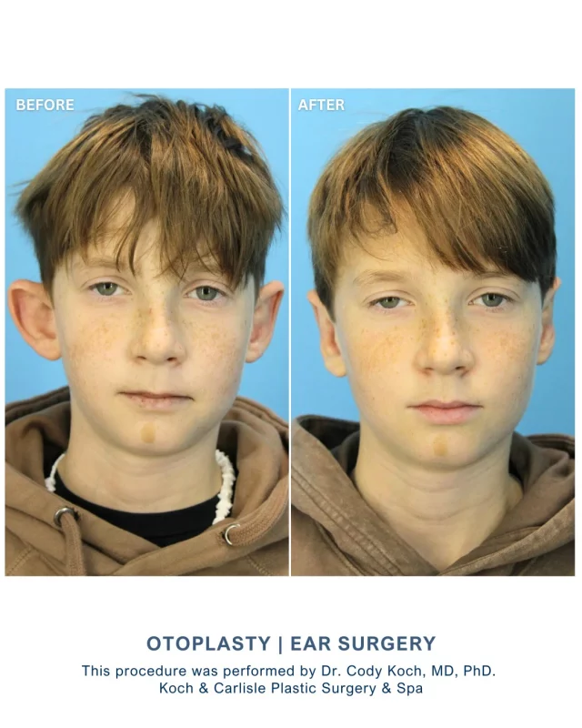 Dr. Cody Koch, MD, PhD performed an Otoplasty to reposition our patient's ears. Our patient is so happy with his results and noted he feels more confident - we're thrilled for him! 🩵

Dr. Koch performs Otoplasty procedures to reposition protruding ears closer to the head. This procedure can be performed on adults and children ages 5 and older, when ears are at or near their full size. 

There is very little discomfort during an Otoplasty, where our patients can resume a fairly normal schedule within a week. 

At Koch & Carlisle Plastic Surgery, ear surgery prices vary depending on your specific needs. When you come in for a consultation, you will receive a detailed quote based on our surgeon’s assessment of your needs and cosmetic goals.

Interested in meeting with Dr. Koch for an in-person consultation? We would love to help:
➡ Speak with a member of our team | 515-277-5555, press "1" for consultations
➡ Inquire online | https://www.kochandcarlisle.com/consultation-mobile/

.
.
.
.
#boardcertifiedplasticsurgeon #boardcertified #facialplasticsurgery #otoplastybeforeandafter #otoplasty #earsurgery #otoplastysurgery #drcodykoch #kochandcarlisleplasticsurgery #westdesmoines #westdesmoinesiowa