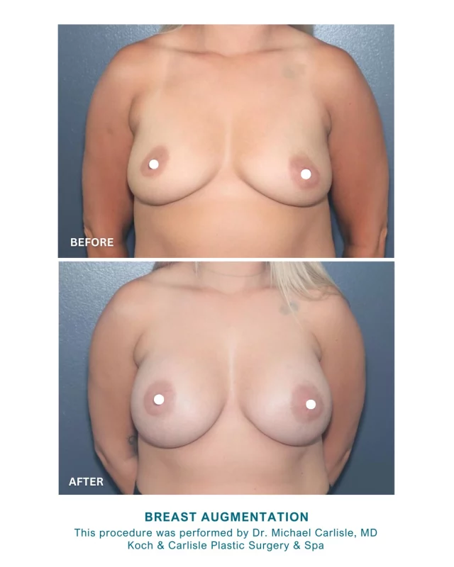 Our patient, 34, "couldn't be happier" with her results following her breast augmentation procedure with Dr. Carlisle! 👏

Breast Augmentation is tailored to each patient’s preferences and lifestyle. Our patient’s outcome shows natural-looking enhancement with symmetry and improvement in breast shape. During her procedure, she received 405cc gummy bear implants. 

Our patient noted she "absolutely loves" her results, sharing that "Dr. Carlisle and staff are super amazing!" We're so happy to hear about her positive experience with Koch & Carlisle Plastic Surgery & Spa. 🩵

Dr. Michael Carlisle is a board-certified plastic surgeon with specializes in breast and body procedures at Koch & Carlisle Plastic Surgery & Spa. 

Interested in meeting with Dr. Carlisle for an in-person consultation? We would be happy to help: 
➡ Speak with a member of our team | 515-277-5555
➡ Inquire online | https://www.kochandcarlisle.com/consultation-mobile/

.
.
.
.
#breastaugmentation #breastaug #boardcertified #boardcertifiedplasticsurgeon #kochandcarlisleplasticsurgery #westdesmoines #westdesmoinesiowa #mommymakeover