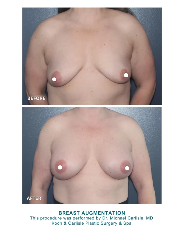 Our patient, 45, is thrilled with her results following her breast augmentation with Dr. Michael Carlisle! She received 485cc silicone implants during her procedure. 

From our Patient: "I love my results! They look natural and they've given me my confidence back."

Dr. Carlisle is a board-certified plastic surgeon who exclusively performs breast and body procedures at Koch & Carlisle Plastic Surgery & Spa in West Des Moines. Dr. Carlisle performs breast augmentation surgeries several times each week, making it one of his most common procedures.

Women pursue breast augmentation for various personal reasons. Often, it’s because they want to:
✔ Increase the size of naturally small breasts
✔ Restore volume lost after pregnancy or weight loss
✔ Improve uneven or asymmetrical breasts
✔ Enhance feminine proportions and contours

Studies show that women experience improved self-esteem and quality of life after breast augmentation.

Interested in meeting with Dr. Carlisle for an in-person consultation? We're happy to help!
➡ Inquire online | https://www.kochandcarlisle.com/contact-us/
➡ Speak with a member of our team | 515-277-5555

.
.
.
#breastaugmentation #breastaug #boardcertifiedplasticsurgeon #boardcertified #breastprocedure #breastimplants #westdesmoines #westdesmoinesiowa #iowaplasticsurgery #kochandcarlisleplasticsurgery