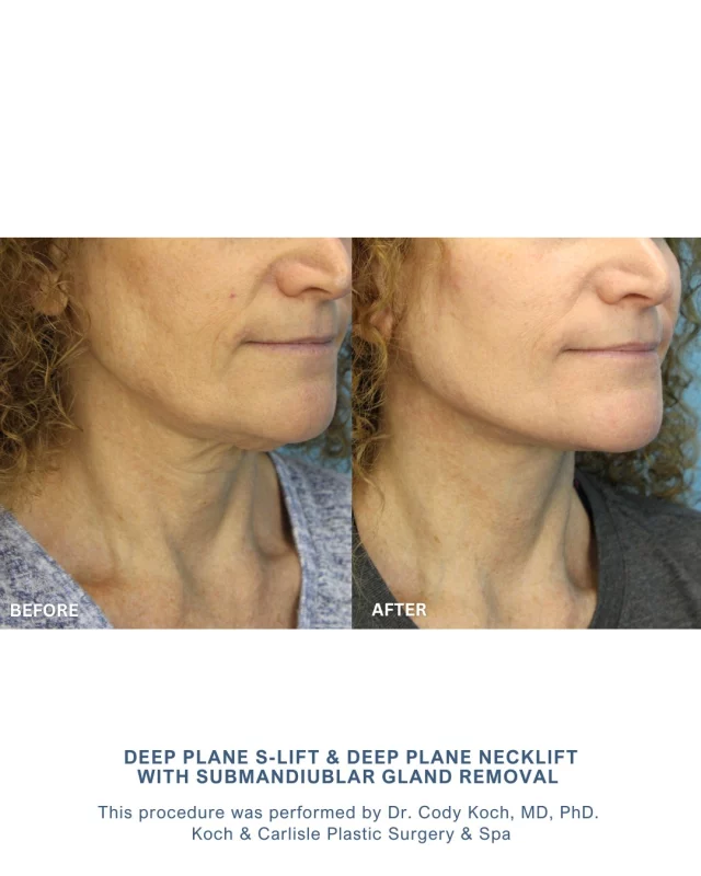 Take a look at our patient's gorgeous results following her custom facelift procedure with Dr. Cody Koch, MD, PhD of Koch & Carlisle Plastic Surgery. 

Our patient's custom procedure with Dr. Koch included a Deep Plane S-Lift, a Deep Plane Neck Lift, and removal of her submandibular glands to decrease fullness in the neck and add more definition. 

These techniques were selected to carefully reposition deeper facial tissues and define her neckline, all while prioritizing natural-looking outcomes.

Following her procedure, our patient's results included an overall improvement in her facial contours, a more defined neck, and a restored jawline. Additionally, receiving a facelift can result in a decrease in premature wrinkles, an increase in skin elasticity, and an overall improved appearance. 

Most patients return to work or social activities within 10–14 days, though it’s best to schedule surgery at least 1–2 months before a major event to allow for full healing.

Whether you are seeking a subtle, natural enhancement, or more of a significant change – our tailored approach ensures optimal results with minimized downtime.

Interested in scheduling an in-person consultation with Dr. Cody Koch? We're happy to help:
* Speak with a member of our team | 515-277-5555
* Inquire online | https://www.kochandcarlisle.com/consultation-mobile/