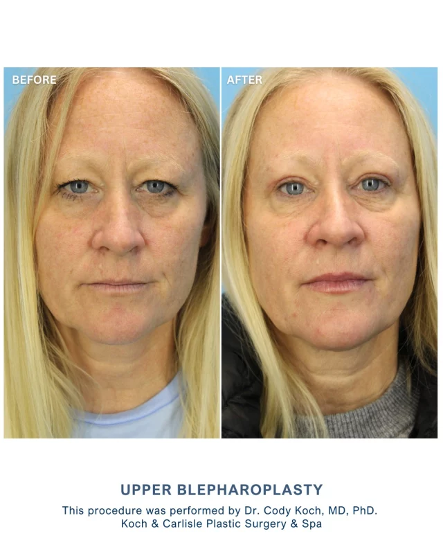 Our patient is so happy with her results following her upper blepharoplasty with Dr. Cody Koch, MD, PhD of Koch & Carlisle Plastic Surgery & Spa.

From Our Patient | How she feels about her results: "Great! I love the results."

Following her upper blepharoplasty, her upper eyelid contour is now more defined, and her eyes appear brighter and more open while still looking authentic to her facial features. We're so happy for her! 

Eyelid Surgery can offer significant improvements in facial aesthetics and comfort for patients with similar concerns. Dr. Cody Koch brings extensive training in facial plastic surgery, including board certification in Facial Plastic and Reconstructive Surgery and Otolaryngology-Head and Neck Surgery. 

As part of his practice at Koch & Carlisle Plastic Surgery & Spa, Dr. Koch is committed to patient-centered care and natural-looking outcomes. His background in medical education and research supports his meticulous approach and dedication to achieving individualized results.

Interested in learning more this procedure? We're happy to help:
➡ Visit our photo gallery | https://www.kochandcarlisle.com/photo-gallery/
➡ Read more about eyelid surgery | https://www.kochandcarlisle.com/plastic-surgery/eyelid-surgery/
➡ Request a consult with Dr. Koch | 515-277-5555, press "1" for consults 

Koch & Carlisle Plastic Surgery & Spa is located in West Des Moines, Iowa. 
www.kochandcarlisle.com 
515-277-5555

.
.
.
.
#boardcertified #boardcertifiedplasticsurgeon 
#upperblepharoplasty #uppereyelidsurgery #eyelidsurgery #kochandcarlisle #kochandcarlisleplasticsurgery #westdesmoines #iowamedspa #plasticsurgeon #eyelidlift #plasticsurgeryresults #plasticsurgeryclinic #americanboardoffacialplasticandreconstructivesurgery #mayoclinictrained