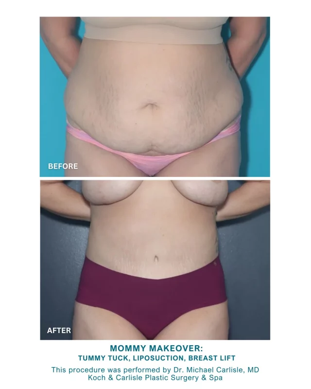 Our patient says her confidence is back following her customized Mommy Makeover procedure with Dr. Michael Carlisle, MD, of Koch & Carlisle Plastic Surgery & Spa. 🩵

From our patient | How I feel about my results:
➡ “Happy, excited, thankful. I feel confident with my body again.”

We are so happy for her!

Our patient is a mother of two who opted for a customized Mommy Makeover, which included a tummy tuck, liposuction, and a breast lift performed by Dr. Carlisle. Her “after” photos were taken 12 months post-procedure.

Interested in meeting with Dr. Carlisle for an in-person consultation? We would love to assist you!
➡ Speak with a member of our team | 515-277-5555
➡ Inquire online | https://www.kochandcarlisle.com/consultation-mobile/