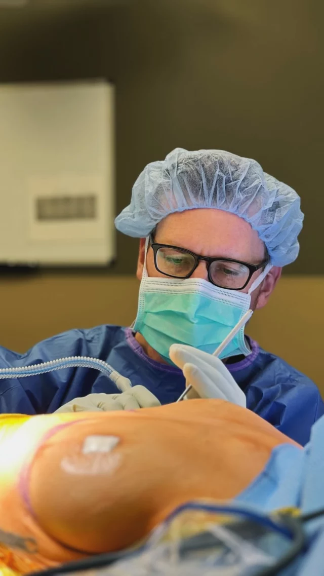 Our patient first had a breast lift with Dr. Carlisle to restore shape and support after three pregnancies, breastfeeding, and significant weight loss. Once her breasts fully healed and settled, she had a much clearer sense of what she wanted in terms of volume. Six months later, Dr. Carlisle added implants to restore upper-pole fullness — choosing 330 CCs, moderate profile, gummy bear implants that fit her body, lifestyle, and goals.

A staged approach like this can be helpful when shape is the primary concern at first, and volume is something you want to fine-tune later.  It allows your tissues to heal, your results to settle, and your decisions to be made with confidence — not pressure.

That said, many patients do beautifully with a lift and augmentation done at the same time. The “right” approach depends on your anatomy, your goals, and how much certainty you have about size from the start.

There is no one-size-fits-all answer — and at Koch & Carlisle Plastic Surgery, we proudly specialize in thoughtful planning, honest conversations, and a plan that’s built around YOU!

Interested in meeting with Dr. Carlisle? We would love to get you set up:
🩵 Speak with a member of our team | 515-277-5555

@kandcplasticsurgery 
@drcarlisleplasticsurgery 
#breastaugmentation #boardcertifiedplasticsurgeon #westdesmoines #breastsurgery #kochandcarlisleplasticsurgery