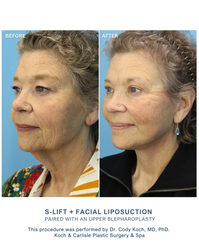 Our patient, 61, received an S-Lift with facial liposuction to the neck and jowls, along with an upper blepharoplasty (upper eyelid lift), performed by Dr. Cody Koch, MD, PhD of Koch & Carlisle Plastic Surgery & Spa.

Our patient was thrilled with her results following her procedure, stating: “So pleased! Happy with such a natural result.”

Dr. Koch exclusively performs face and neck surgery at Koch & Carlisle Plastic Surgery & Spa. As a board-certified plastic surgeon, he offers a wide variety of procedures, including facelifts, facial liposuction, rhinoplasty, eyelid surgery (upper and lower), and skin cancer reconstruction.

While Dr. Koch is recognized for his artistic skill and thoughtful surgical approach, patients commonly praise his calming demeanor, attentiveness throughout their surgical experience, and the reassurance he provides.

It is not uncommon to receive a courtesy call from Dr. Koch after surgery to check on your progress.

Interested in meeting with Dr. Koch for an in-person consultation? We would love to help:
➡ Speak with a member of our team | 515-277-5555
➡ Inquire online | Click the link in our bio to “Request a Consultation”

.
.
.
.
@kandcplasticsurgery 
#kochandcarlisleplasticsurgery #boardcertifiedplasticsurgeon #facelift #faceliftsurgery #facialliposuction #liposuction #westdesmoines #westdesmoinesiowa #plasticsurgery #plasticsurgeryresults #cosmeticsurgery #uppereyelidsurgery