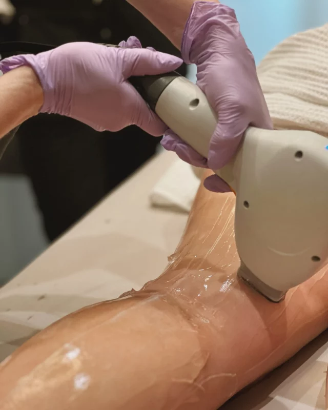 Experience smooth skin by summer with laser hair reduction! ⚡

We’re so excited to offer our patients the BareHR by Sciton—our newest laser hair reduction device—now available at Koch & Carlisle Spa.

Enjoy quick treatments with lasting results, as this device can treat larger areas in minutes! Many of our patients appreciate the device’s built-in sapphire contact cooling, which helps keep skin cool and comfortable during treatment.

Laser hair reduction can be performed on many areas of the body, including the arms, legs, underarms, face, chin, bikini, and Brazilian.

This quarter, save 20% on our laser hair reduction package, which includes 6 treatments on your desired area. (We recommend 6 treatments for optimal results!)

Interested in learning more? We’d love to connect with you for a complimentary skincare consultation:
➡ Speak with a member of our team: 515-277-5555, press “2” for the spa
➡ Inquire online: ask@kochmd.com