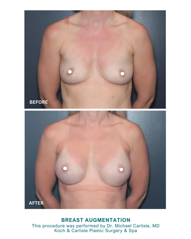 Our patient is so happy with her results following her customized breast augmentation performed by Dr. Michael Carlisle, MD, of Koch & Carlisle Plastic Surgery & Spa. 🩵

Her custom procedure included placement of a 295cc implant on her right side and a 275cc implant on her left to enhance balance and create a subtle but noticeable change.

Dr. Carlisle is a board-certified plastic surgeon known for his personalized approach to creating attractive, natural-looking results with breast implants.

Swipe to see her results! 👏

During your consultation, you will be “sized” using a Volume Sizing System that creates a more realistic preview of your new size on your body. A series of soft, sterilized silicone inserts are placed over your breasts inside a sports bra until your desired proportions are achieved.

It’s important to see how a new size looks on your body when choosing an implant size.

Check out more of Dr. Carlisle’s work in our online Before & After photo gallery:
➡ Before & After photos | https://www.kochandcarlisle.com/photo-gallery/

.
.
.
.
#breastaugmentation #breastaug #beforeandafter #boardcertifiedplasticsurgeon #boardcertified