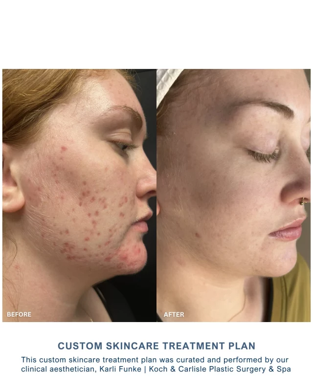 Our patient is so happy with her results following a custom skincare plan  developed by our clinical aesthetician, Karli Funke. 🩵

Her custom plan included both skincare products and clinical treatments, which were performed by Karli at Koch & Carlisle Spa. Swipe to see her beautiful results! 

Our licensed and highly skilled aestheticians provide individual, comprehensive consultations to help determine your precise skin type and the right products and services to achieve optimal results and bring you closer to your cosmetic goals. Our skincare consultations are complimentary at Koch & Carlisle Spa. 

Interested in learning more about our range of skincare products and treatments? We're here to help:
✔ Speak with a member of our team | 515-277-5555, press "2" for the spa
✔ Inquire Online | https://www.kochandcarlisle.com/consultation-mobile/

.
.
.
.
#skincare #iowamedicalspa #laserskincare #medicalgradeskincare #kochandcarlisle
