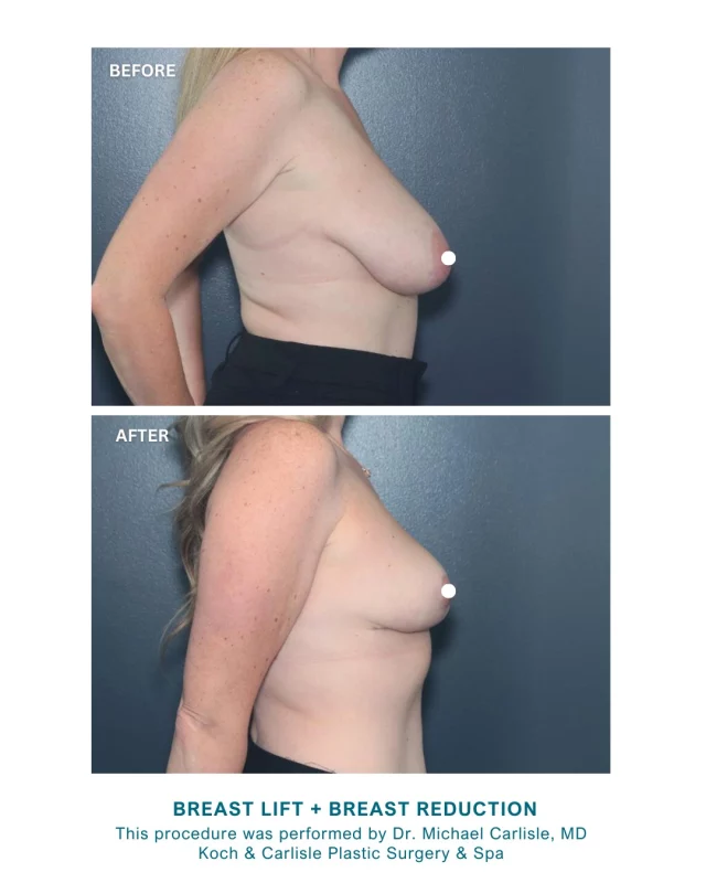 "I'm extremely happy with my results. Life-changing for me."

Our patient, 39, chose to undergo a breast lift and breast reduction due to ongoing discomfort from large, heavy breasts. She experienced persistent neck and shoulder pain, as well as bra strap grooving that affected her daily activities. 

Dr. Michael Carlisle, MD performed a breast reduction and lift, removing one pound of breast tissue from each side. The photos above show her progress three months post-surgery; over time, the surgical scars will continue to fade. 

Swipe to see her full results! 🩵

Dr. Carlisle is a board-certified plastic surgeon who exclusively performs breast and body procedures. He is recognized for his thorough surgical approach and dedication to patient-centered care, helping individuals achieve improved well-being and confidence.

Interested in meeting with Dr. Carlisle for an in-person consultation? We would love to help! Reach out today:
➡ Speak with a member of our team | 515-277-5555, press "1" for consultations
➡ Inquire online | https://www.kochandcarlisle.com/consultation-mobile/

.
.
.
#boardcertifiedplasticsurgeon #breastlift #breastreduction #kochandcarlisleplasticsurgery