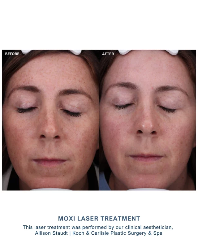 Glowy skin after just one MOXI laser treatment!

This MOXI laser treatment was performed by our clinical aesthetician, Allison.

The MOXI comfortably delivers non-ablative laser energy to correct the early signs of sun damage and aging. This treatment can be safely administered at any time of year, provided there is no active tanning or sunburn present.

Topical numbing is required for this treatment. Please anticipate up to 7 days of downtime, which may include dry texture, slight to moderate swelling, and skin sloughing. Your skin will appear brighter around one week following treatment. ✨

Interested in learning more? We would love to schedule you for a complimentary, in-person consultation with a member of our spa team:

🩵 Speak with a team member | 515-277-5555, press “2” for our spa
🩵 Book your consultation online | https://book.mypatientnow.com/practice/SxtdU