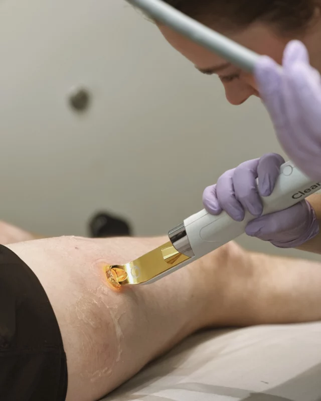 Treat unwanted vascular lesions with ClearV! ⚡

This quick treatment can target and treat a variety of skin lesions, including visible vessels, broken capillaries, spider veins, vascular lesions, skin discoloration, and cherry angiomas.

This quick treatment is done at Koch & Carlisle Spa by our clinical aestheticians and offers no downtime. Depending on the size of the area, your treatment lasts anywhere from 5 to 30 minutes.

Interested in seeing if you would be a candidate for ClearV? We would love to get you set up for a complimentary skincare consultation at Koch & Carlisle Spa:
🩵 Speak with a member of our team | 515-277-5555, press “2” for the spa
🩵 Book your consultation online | https://book.mypatientnow.com/practice/SxtdUw